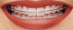 clear braces orange county ca