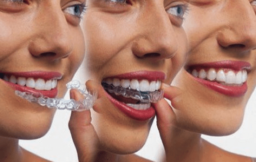 Ceramic Braces  Braces & Invisalign in Orange County