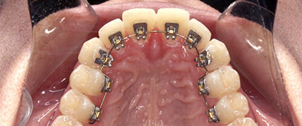 What in the World Are Lingual Braces?
