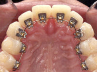Why lingual braces are the best for recreational activities