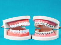 From Ancient Techniques to Modern Marvels: The Fascinating Evolution of Dental Braces