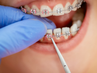 Dealing with Broken Brackets or Wires: A Guide to Managing Orthodontic Emergencies