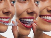 Navigating Discomfort During Your Braces Journey: Strategies for a More Comfortable Experience